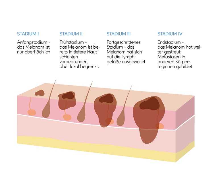 Stadien Schwarzer Hautkrebs | Leben Mit Hautkrebs